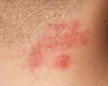 Milyen betegségek okozhatnak vörös foltokat a bőrön? - Állatok